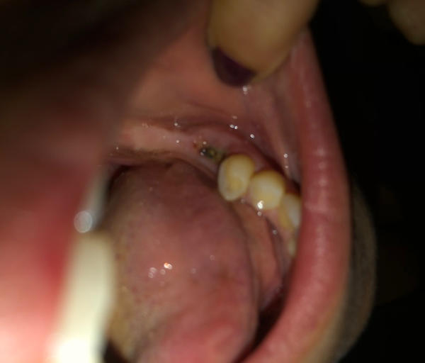 Wisdom Tooth Extraction Is This Normal Dry Socket