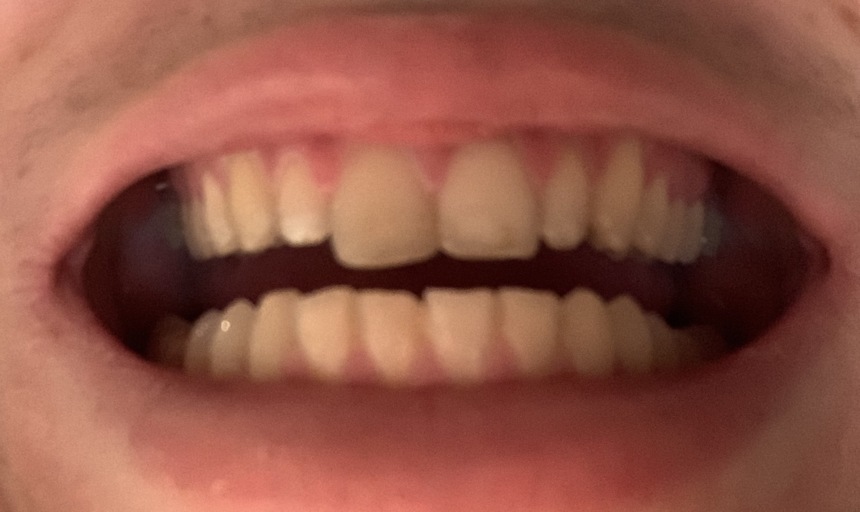 invisalign gums incisors overbite retainers shifted crooked molar hurting removing overcrowding alternative bracesinfo
