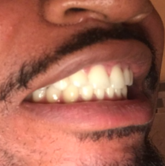 bulimia fell uncomfortable veneers expander bracesinfo