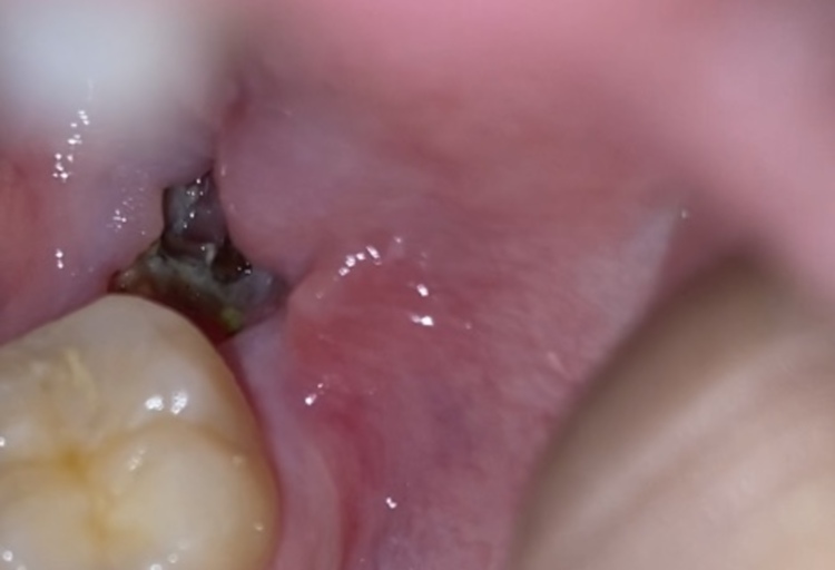 So I have dry socket? Is it infected or healing well? 9 days after ...