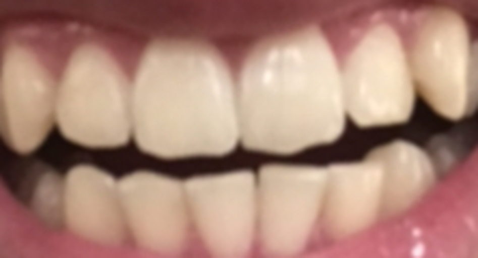 Amazing The Gap Where A Large Canine Tooth Can Rest Moment Illustration Amazing The Gap Where A Large Canine Tooth Can Rest Moment Illustration