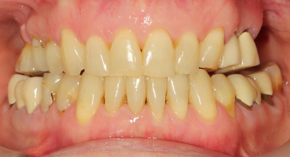 downwards orthodontic adjust