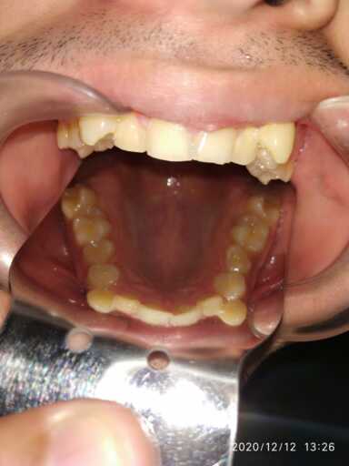 should i fill the gap after tooth extraction should i fill the gap after tooth extraction