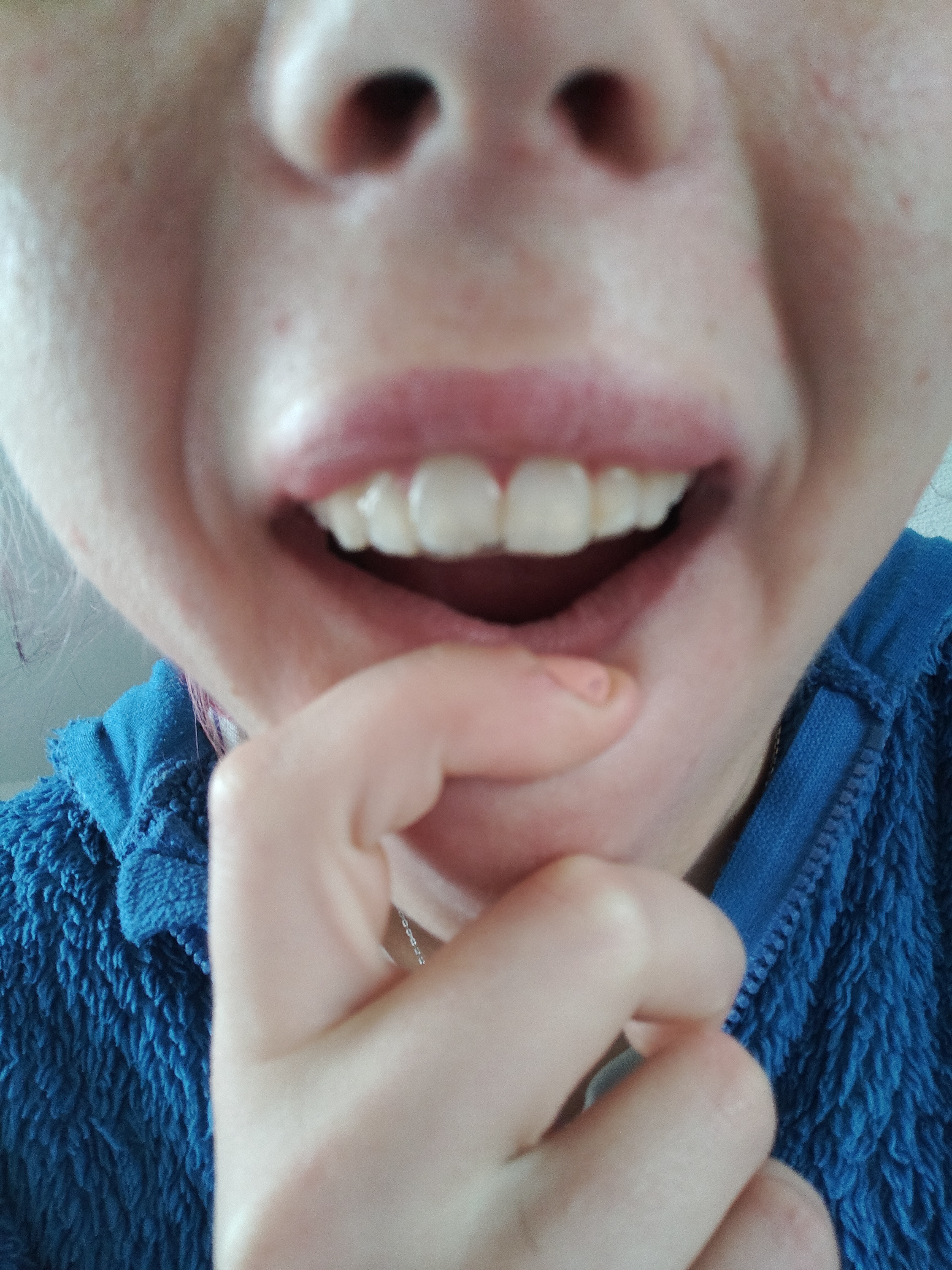 retainer doesn't fit